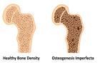 Osteogenesis imperfecta