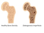 Osteogenesis imperfecta