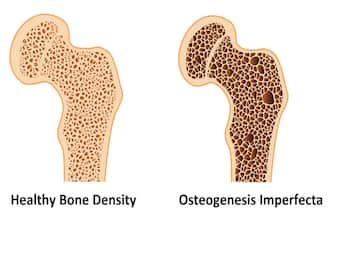 Osteogenesis imperfecta