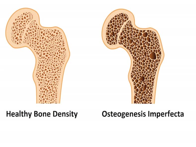 osteogenesis-imperfecta