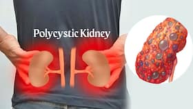 Polycystic Kidney: 10 Signs You May Have Chronic Kidney Disease