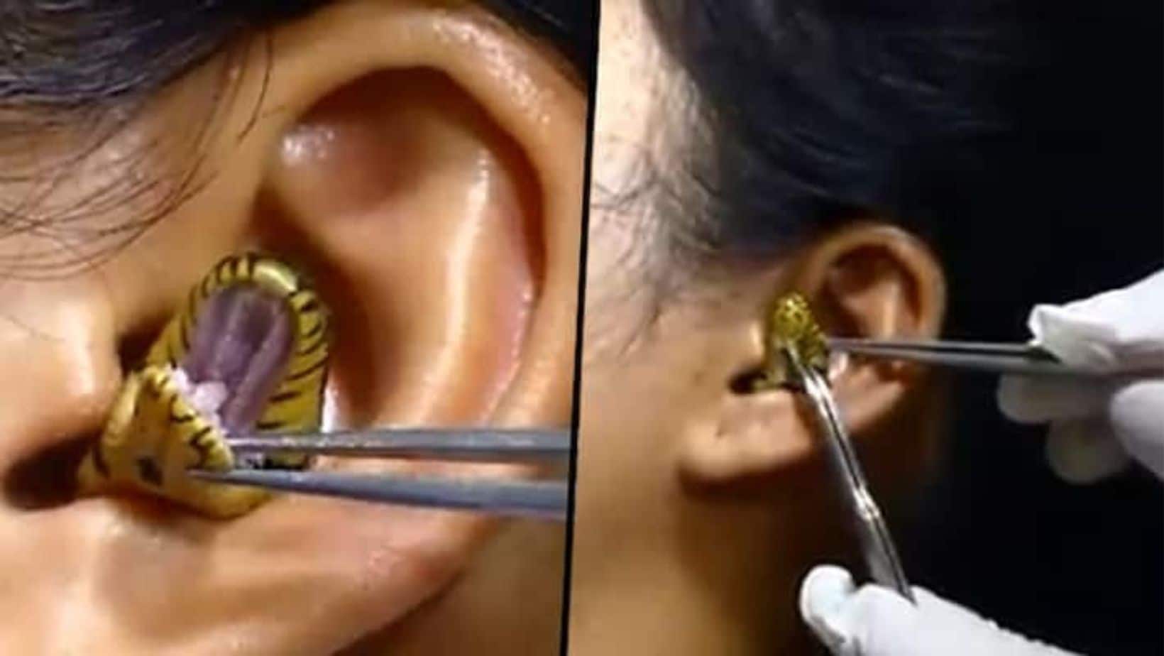 How To Treat Infected Ear Piercings From Dermatologist
