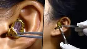 Video of Snake Stuck Inside Woman's Ear Gets VIRAL: What Are The Dangers of Snake Bites?