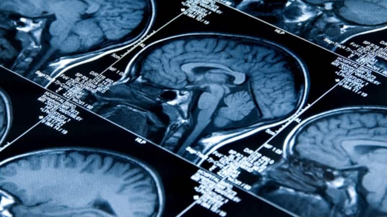 Brain Aneurysm: 9 Unusual Symptoms Of This Condition That Can Lead To Hemorrhagic Stroke
