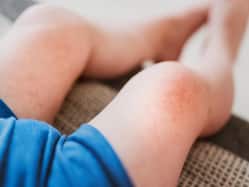 Eczema in children: New Drug Highly Effective In Reducing Itch, Other Symptoms