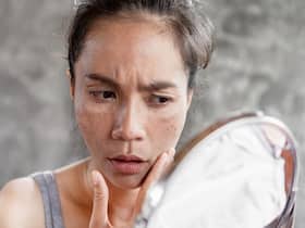 Pigmentation Disorders: Japan Scientists Identify Role Of Sensory Neurons In Skin Pigmentation
