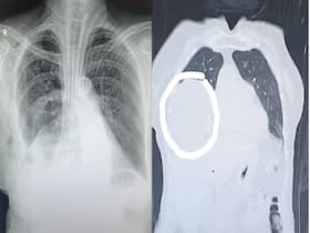Big Tumour Removed From A Woman   s Chest: Do Not Ignore Persistent Symptoms Like Shortness Of Breath