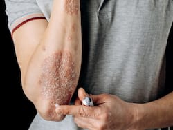 Side Effects Of Topical Steroids On The Skin