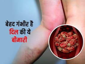 Venous thromboembolism: नसों में क्लॉटिंग के कारण होती है ये दिल की बीमारी, जानें क्या है ये? Venous thromboembolism: नसों में क्लॉटिंग के कारण होती है ये दिल की बीमारी, जानें क्या है ये?