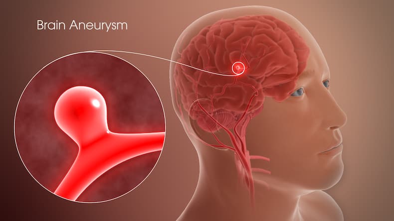 Brain Aneurysm: 9 Unusual Symptoms Of This Condition That Can Lead To Hemorrhagic Stroke