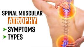 Spinal Muscular Atrophy: What Is SMA, Symptoms & Diagnosis, Expert Speaks, Watch Video