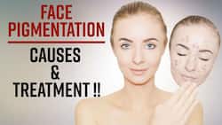 Hyperpigmentation: What Are The Root Causes & How To Treat Hyperpigmentation, Watch Video