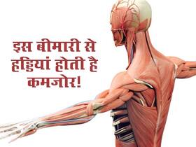 शरीर में छिपी इस Chronic Disease की वजह से हड्डियां हो रही कमजोर! 24 फीसदी तक हड्डियों को पहुंचता है नुकसान