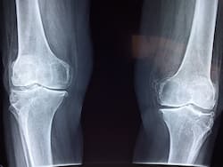 Menopause Speeds Up Bone Loss, Tips To Reduce The Risk Of Osteoporosis