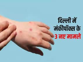 दिल्ली में सामने आए मंकीपॉक्स के 3 नए मामले, LNJP अस्पताल में चल रहा है इलाज