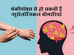 मंकीपॉक्स के कारण लोगों को हो सकती है न्यूरोलॉजिकल समस्याएं, दिमाग पर पड़ सकता है गहरा प्रभाव