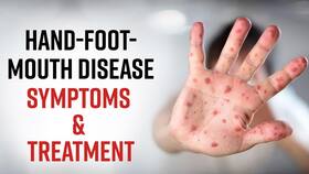 Hand Foot Mouth Disease: Know The Symptoms & Treatment Of The HFM Disease, Watch Video