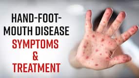 Hand Foot Mouth Disease: Know The Symptoms & Treatment Of The HFM Disease, Watch Video