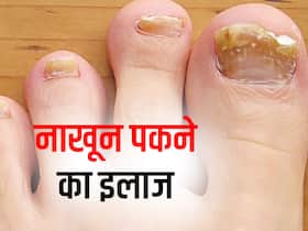 नाखून पकने पर क्या करें? आजमाएं ये 5 आसान टिप्स