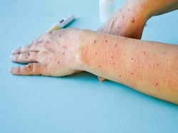 टोमाटो फ्लू को रोकने के लिए चंड़ीगढ़ प्रशासन ने बताया खुद कैसे करें उपाय, पढ़ें एडवाइजरी में लिखी जरूरी जानकारी