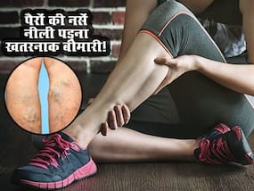Varicose veins: पैरों की नसें नीली पड़ना भयंकर बीमारी का संकेत, दर्द शुरू होने से पहले ही करें ये उपाय