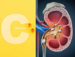 Vitamin C का अधिक सेवन बन सकता है Kidney Stone की वजह, जानिए एक दिन कितना विटामिन सी लेना है सही