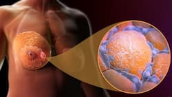 Breast Cancer Detection In India: Major Breakthroughs In Treatment For Breast Cancer