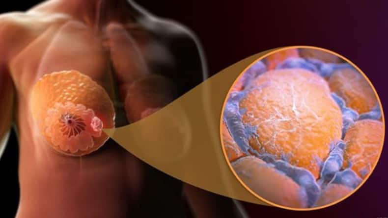 Self-Breast Examination: Here's Why It Matters?