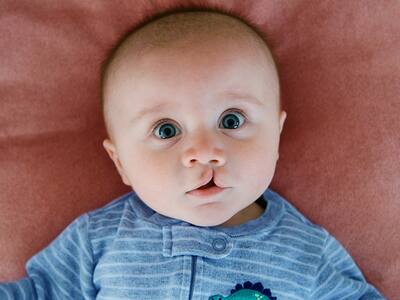 Cleft Surgery: Beyond Smiles, Changing Lives | TheHealthSite.com