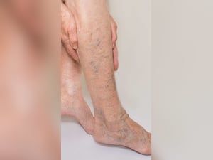 हाई कोलेस्ट्रॉल में दिखते हैं ये 8 लक्षण