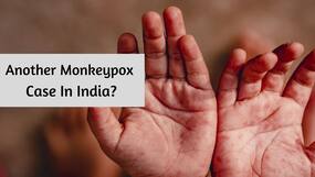 12-Year-Old Karnataka Girl Develops Monkeypox Symptoms, State Government Issues High Alert