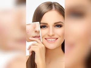 पिम्पल्स से बचने के लिए 9 टिप्स