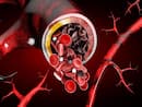 Sickle Cell Disease: Who Is Susceptible To Sickle Cell Anaemia?