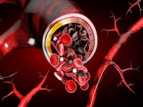 Sickle Cell Anemia Is A Leading Cause Of Stroke In Children And Teens: CDC Vital Signs Report