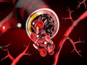 Sickle Cell Disease: Who Is Susceptible To Sickle Cell Anaemia?