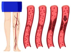 Blood Clots Can Happen To Anybody At Any Age: Factors That Increase Your Risk Of Venous thromboembolism