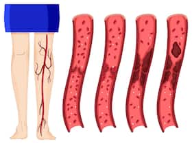 Blood Clots Can Happen To Anybody At Any Age: Factors That Increase Your Risk Of Venous thromboembolism