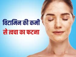 इस विटामिन की कमी से सर्दियों में ज्यादा फट सकती है आपकी स्किन, जानें और अपनाएं ये टिप्स