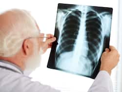 Lung Cancer: Busting 9 Common Myths And Misconceptions