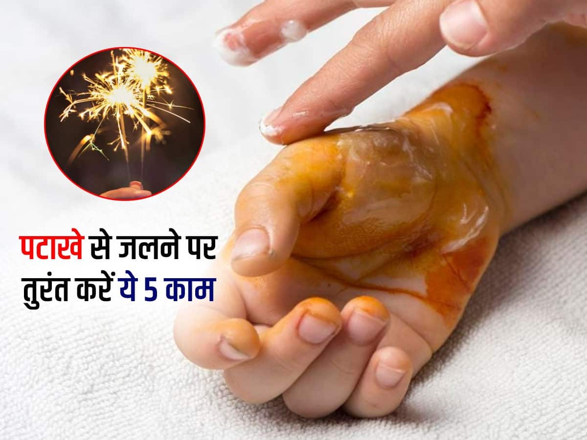दिवाली 2022 पटाखे जलाते समय अगर जल जाए स्किन तो तुरंत करें ये 5 काम