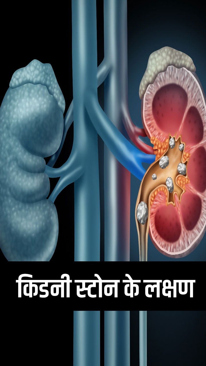 किडनी स्टोन का संकेत देते हैं ये 8 लक्षण