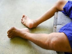 पोलियो के इन 6 लक्षणों को नजरअंदाज करने पर हो सकता है Paralysis! जानें कौन सी गलतियां पड़ती है भारी