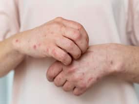 Food Allergy Or Food Intolerance? Know Their Symptoms And Differences