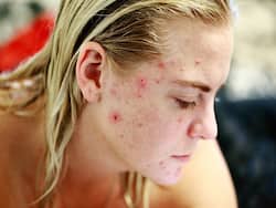 Acne Problems? Know How Birth Control Pills Can Help