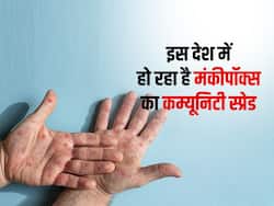 इस देश में मंकीपॉक्स का कम्यूनिटी ट्रांसमिशन होने से मची खलबली, जानें क्या है कम्यूनिटी स्प्रेड और क्यों है यह गम्भीर