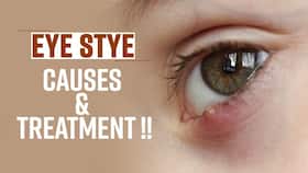 Eye Stye Home Remedies: How To Treat Eye Stye Infection At Home, Watch Video