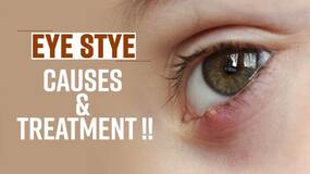 Eye Stye Home Remedies: How To Treat Eye Stye Infection At Home, Watch Video