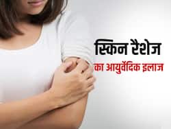 ठंड में स्किन रैशेज से हैं परेशान, तो बिना भूले आज से ही आजमाएं ये आयुर्वेदिक उपाय स्किन बनेगी हेल्दी और सॉफ्ट