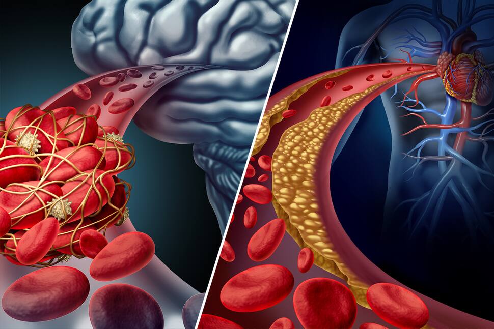 brain-stroke-vs-heart-attack-5-key-differences-you-need-to-know