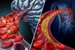 Brain Stroke Vs Heart Attack: 5 Key Differences You Need To Know